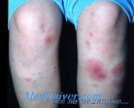 Узловатая эритема. Гистология и дифференциация узловой эритемы