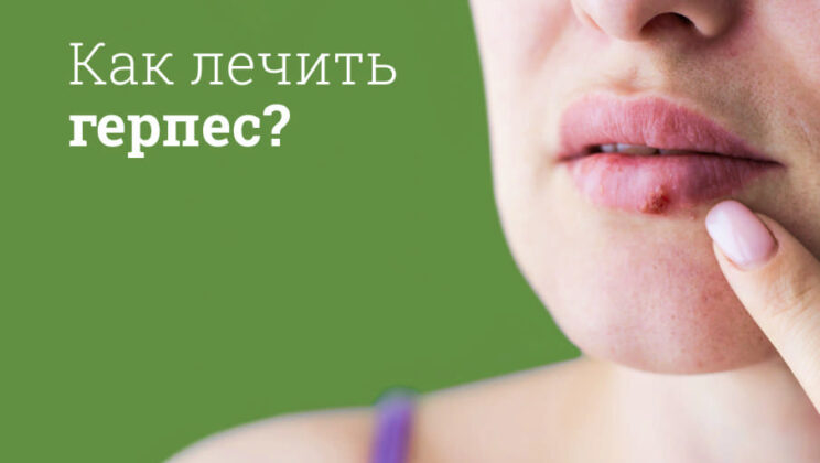 Герпес: Причины, симптомы, лечение